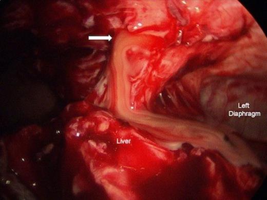 Laparoscopic drainage of anterior inferior mediastinal abscess. Left diaphragm and liver are shown. Arrow = Mediastinotomy.