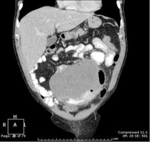 Coronal contrast enhanced CT scan of the abdomen and pelvis demonstrating an homogenous 14.6 x 11 x 14.3 cm intra-abdominal mass closely associated with the small bowel