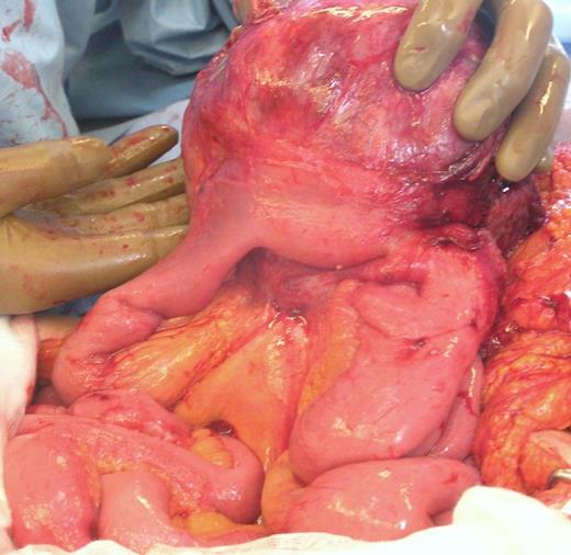 Intra-operative photograph showing tumour arising from small bowel mesentery with local involvement of jejunum