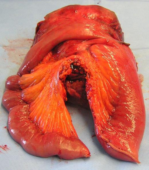 Post-operative photograph showing resected specimen with associated jejunum and its mesenteric pedicle in the foreground