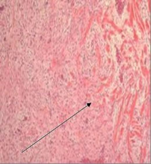 H&E stained section, magnification x 40, demonstrating a bland spindled cell lesion arranged in intersecting ill-defined fascicles, with some intervening collagen fibres and relatively limited infiltration at the lesion margin (arrow)