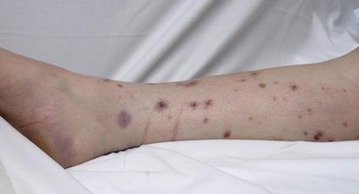 Non blanching papular lesions on patient’s right leg.