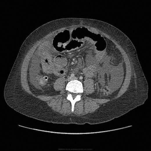 CT scan showing small bowel wall thickening and ascites.