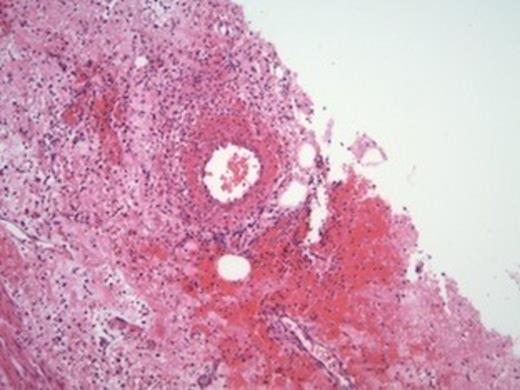A small-sized artery displaying inflammation of the wall and focally fibrinoid necrosis.