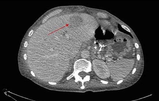 Multiloculated abscess within the left lobe of liver