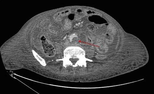 Thrombus within the distal aorta shown by a filling defect (red arrow)