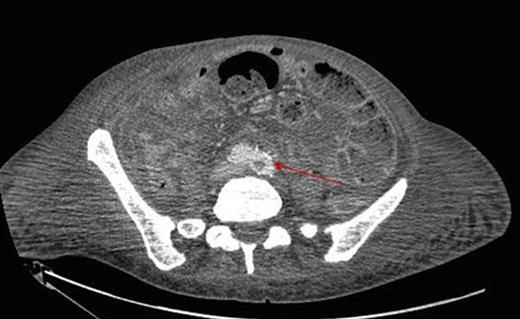 Extension into the left iliac artery shown by a filling defect (red arrow)