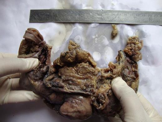 Cut section shows polypoidal growth arising from the ascending colon
