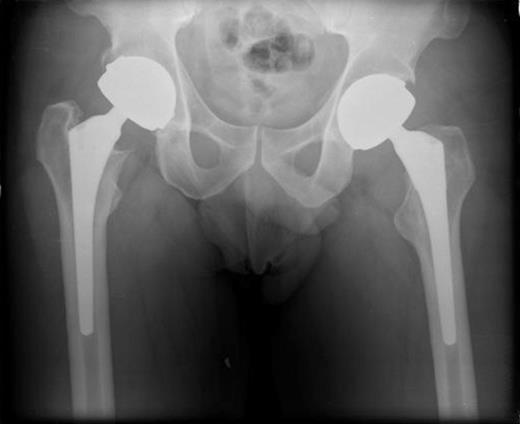 AP Pelvis radiograph demonstrating bilateral metal on metal total hip replacements