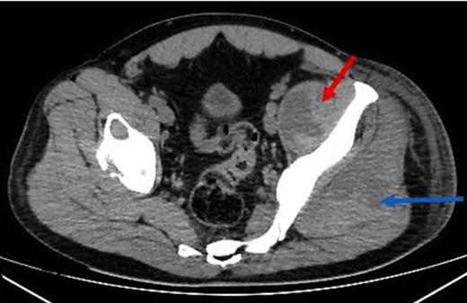 Axial CT demonstrating an irregular low density appearance within the left psoas (red arrow) and gluteal muscles (blue arrow)