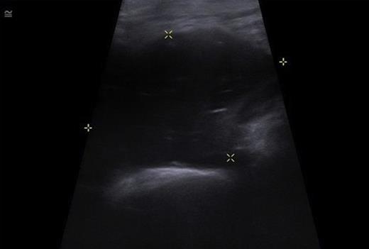 USS of the hip demonstrating a large echogenic collection in the left psoas containing gas.