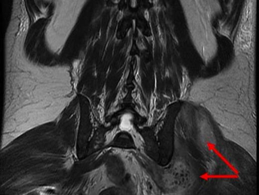 coronal MRI demonstrating ongoing collections around the left hip with low signal foci which may represent metallic debris (red arrow)