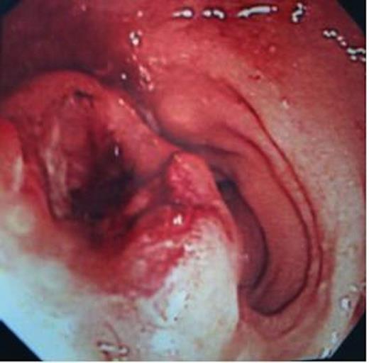 Fungating rectal tumour on colonoscopy