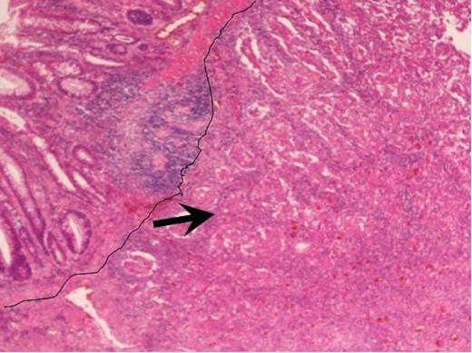 Haematoxylin and Eosin staining of the biopsy specimen. Tumour overlying the large bowel mucosa with the line demarcating the tumour edge with arrow pointing at the body of the tumour (magnificationĂ—4).