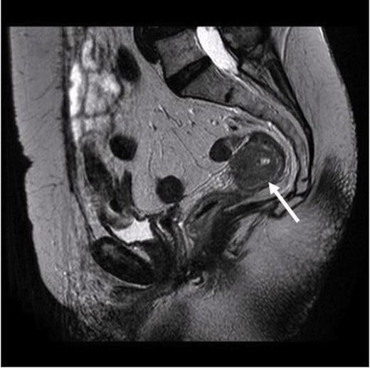 MRI scan. Arrow pointing to the localized tumour in the rectum with no evidence of widespread metastasis
