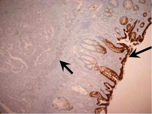 Immunohistochemistry staining of the resected tumour. CK 20 immunohistochemistry positive normal large bowel mucosa with the adenocarcinoma being negative (magnification Ă— 4).