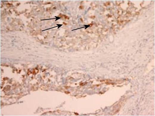 Immunohistochemistry staining of the resected tumour. Arrows identifying positive CK7 staining within tumour (magnification × 4).