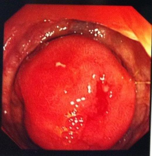 Endoscopic view of the carcinoid tumour in the distal ileum