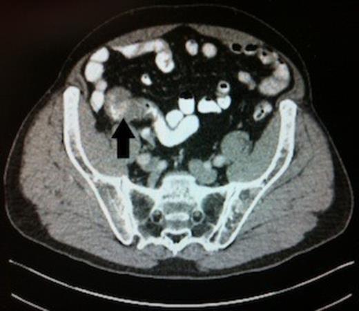 Abdominal CT scan, black arrow highlighting the carcinoid tumour in the distal ileum