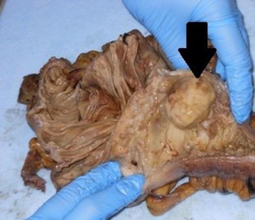 Resected specimen, black arrow demonstrating the carcinoid tumour in the opened distal ileum