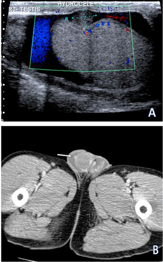 (A) Ultrasound scan demonstrating the largest of multiple small nodules studding into the right tunica vaginalis in addition to a hydrocele. Doppler interrogation suggests that this nodule has parasitized blood flow from the testis. (B) CT scan demonstrating bilateral hydroceles with enhancing nodularity of the tunica vaginalis on the right (arrow)