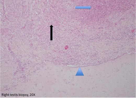 Biopsy from the surface of the right testis (20X). It shows a biphasic exophytic nodule composed of a mixture of epitheloid (blue arrow) and spindled cells (black arrow) with mild to moderate cytological atypia. A shoulder of normal mesothelial lining was included (arrow head). Occasional apoptotic and mitotic figures are present.