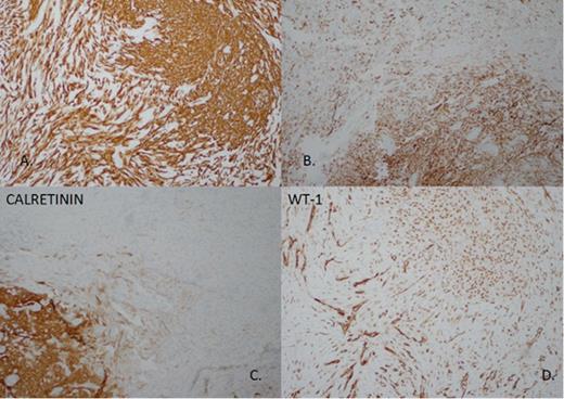 Immunohistochemistry demonstrates: A: Both epitheloid and spindled components are strongly and diffusively positive for pancytokeratin AE1/3. B: To a lesser degree both components stain positively for CAM 5.2, another cytokeratin stain. C: To epithelioid component is positive for Calretinin. D: WT-1 nuclear positivity is seen in both epitheloid and spindled components.
