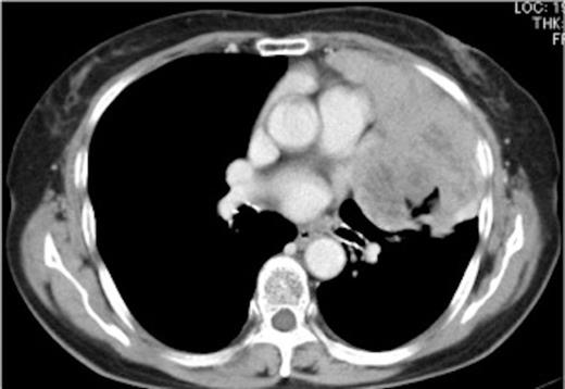 Preoperative chest computed tomography (CT) showing a bulky mediastinal tumor bulging outward into the left thoracic space and invading the pericardium and pleura.