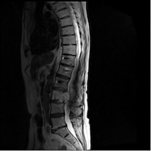 MRI of lumbar spine showing mass causing compression of the cauda