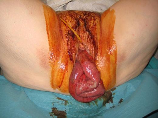 Vaginal evisceration through vaginal vault defect at presentation.