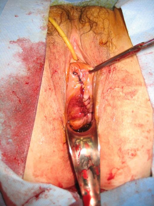After complete reduction of small bowel evisceration and correction of vaginal vault defect.