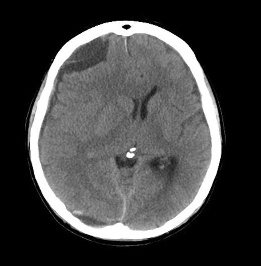 Right acute on chronic SDH
