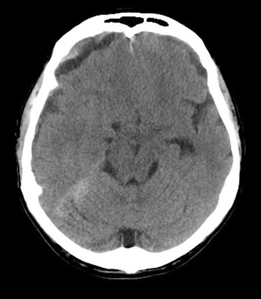 Right acute on chronic SDH