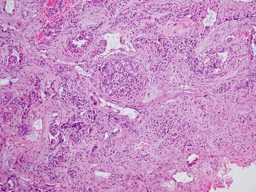 Histopathology Right subdural membranes: extensive infiltration by poorly differentiated adenocarcinoma cells with glandular infiltration (x10).