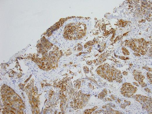 Histopathology Right subdural membranes: Immunoperoxidase staining for PSA (x4)