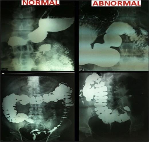 Upper GI contrast studies