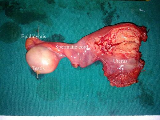 Resected Mullerian duct derivatives of PMDS patient