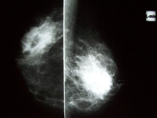 Mammogram