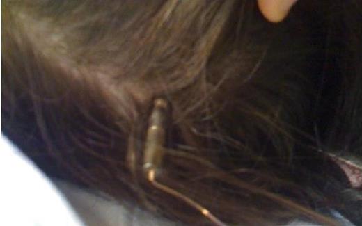 TASER Dart extracranial portion with cautery wire noted