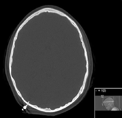 CT head bone windows showing penetration through inner and outer tables of skull intracranially