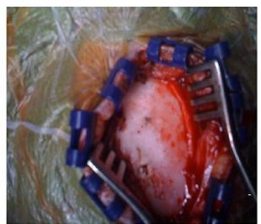 Intraoperative picture showing entry site after extracranial portion broke off