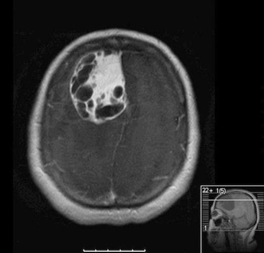Axial MRI with contrast showing heterogenous enhancing solid and cystic component of tumor