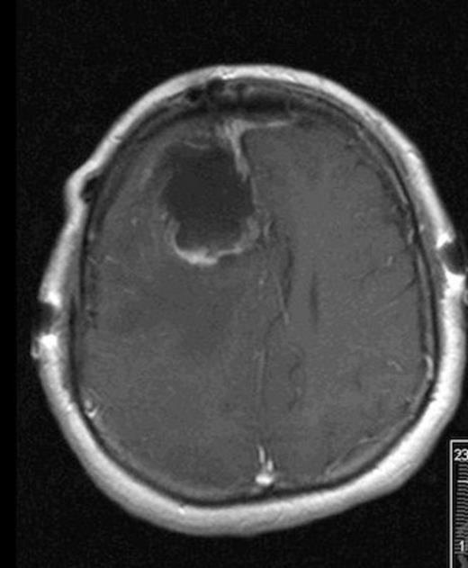 Post-operative MRI showing gross-total resection with some residual blood in cavity