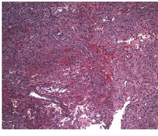 10 x Haematoxylin and Eosin stain showing typical microscopic pathology of capillaries and interstitium