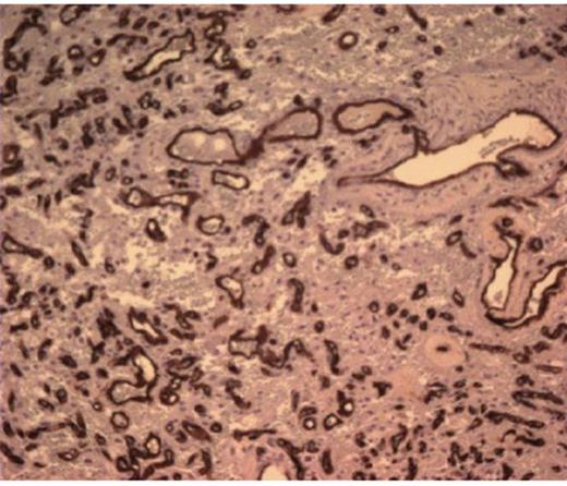 CD 34 positive staining of vascular lining consistent with haemangioblastoma