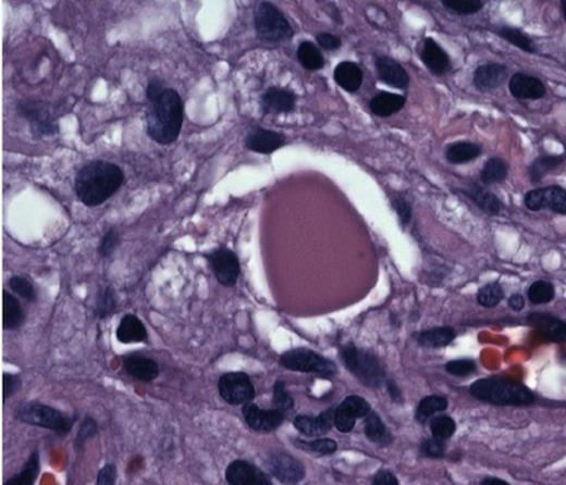 Hyperchromatic nuclei and typical Periodic Acid Schiff + globules at 100x