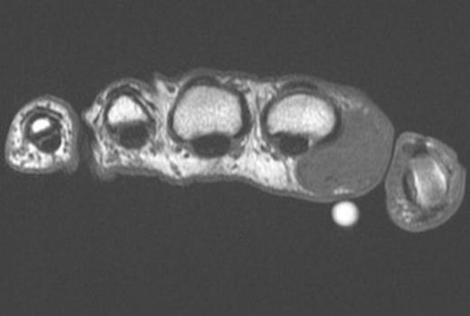 Axial T1 weighted MRI image of the mass and overlying marker (volar white circle)