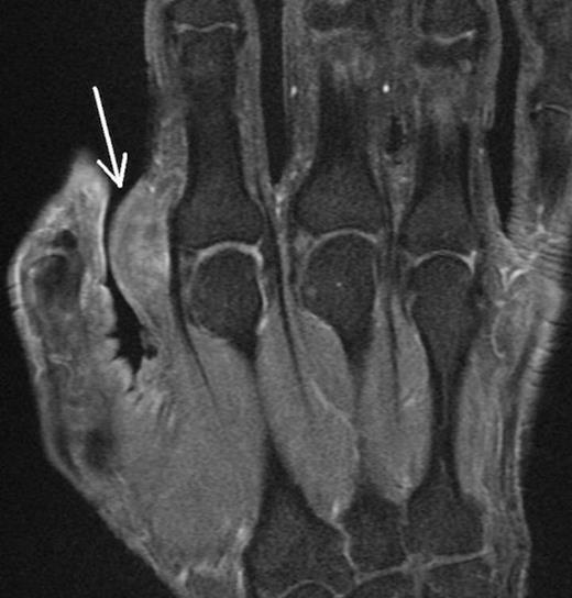 Coronal Fat Suppressed Image of the mass – Depicted by the white arrow