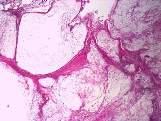 Multicystic appearance of the lesion with fibrous septa. H&E stain, 20X magnification