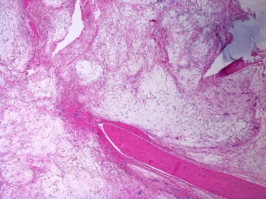 Involvement of a tendon (lower right corner) by the myxoma. Note bluish dense extracellular mucin in the right upper corner. H&E stain, 40X magnification